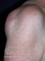 Lipoma (DermNet NZ lesions-lip2).jpg