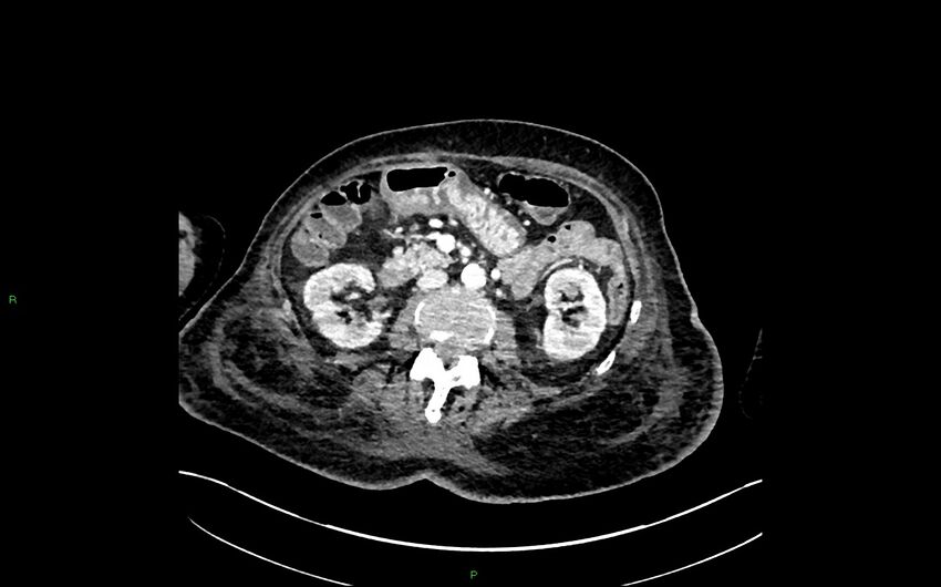 Neo-terminal ileal stricture (Crohn disease) (Radiopaedia 33790-34948 A 188).jpg
