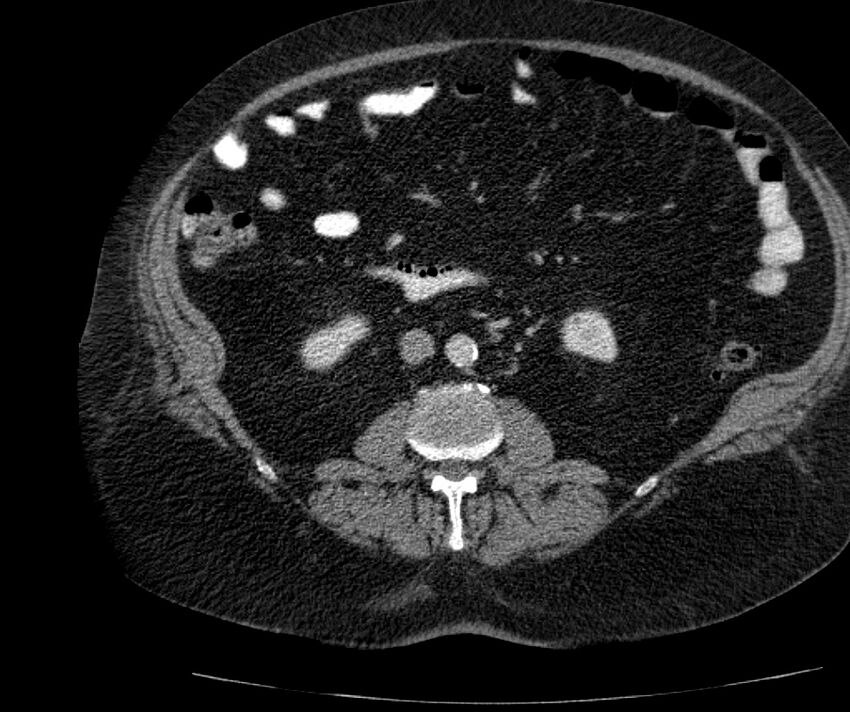 Nephroptosis with inguinal hernia containing perirenal fat (Radiopaedia 56632-63391 C 173).jpg