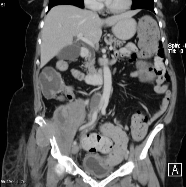 File:Nerve sheath tumor - malignant - sacrum (Radiopaedia 5219-6987 B 3).jpg