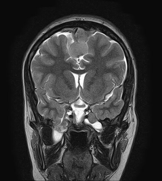 File:Neurofibromatosis type 2 (Radiopaedia 66211-75401 Coronal T2 9).jpg