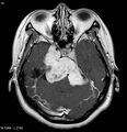 Neurofibromatosis type 2 - cranial and spinal involvement (Radiopaedia 5351-7111 Axial T1 C+ 6).jpg