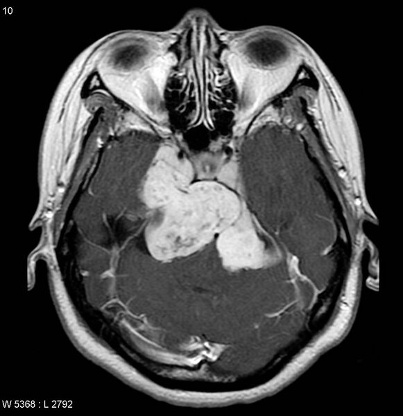 File:Neurofibromatosis type 2 - cranial and spinal involvement (Radiopaedia 5351-7111 Axial T1 C+ 6).jpg