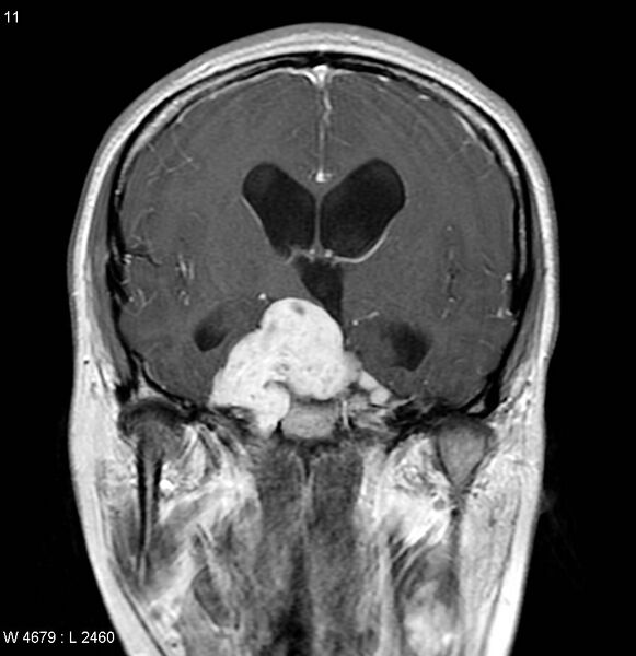 File:Neurofibromatosis type 2 - cranial and spinal involvement (Radiopaedia 5351-7111 Coronal T1 C+ 4).jpg