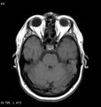 Neurosarcoidosis (Radiopaedia 10930-11351 Axial T1 6).jpg