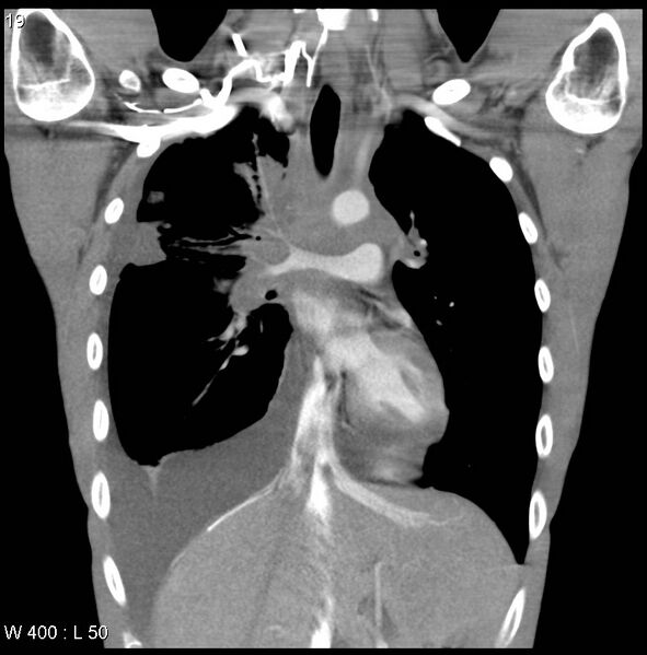 File:Non-Hodgkin lymphoma involving lung (Radiopaedia 29094-29470 C 13).jpg
