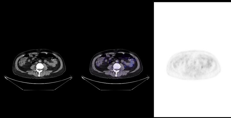 File:Non-Hodgkin lymphoma involving seminal vesicles with development of interstitial pneumonitis during Rituximab therapy (Radiopaedia 32703-33761 ax CT Fus PET 40).jpg