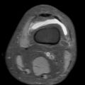 Non-displaced patella fracture (Radiopaedia 15932-15582 Axial PD fat sat 2).jpg