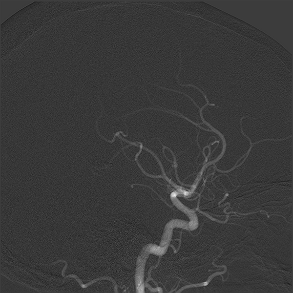 File:Normal cerebral angiogram (four vessel DSA) (Radiopaedia 41708-44649 F 7).png