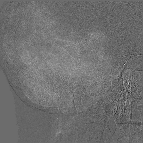 File:Normal cerebral angiogram (four vessel DSA) (Radiopaedia 41708-44649 O 14).png