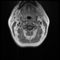 Normal cervical and thoracic spine MRI (Radiopaedia 35630-37156 Axial T1 C+ 24).png