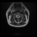 Normal cervical and thoracic spine MRI (Radiopaedia 35630-37156 Axial T2 21).png