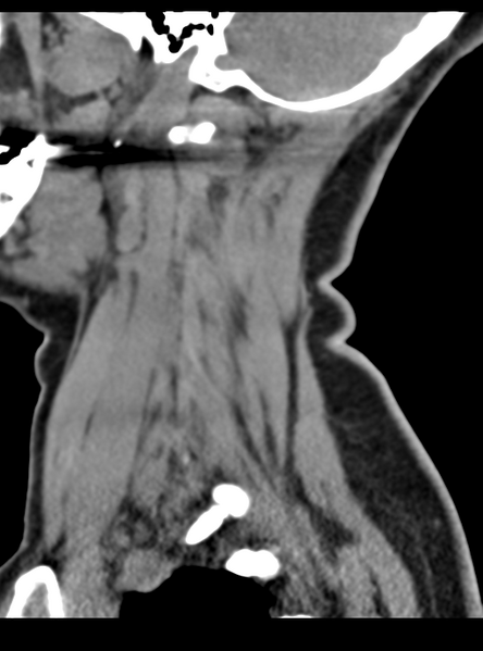 File:Normal cervical spine MRI (including Dixon) (Radiopaedia 42762-45926 C 11).png
