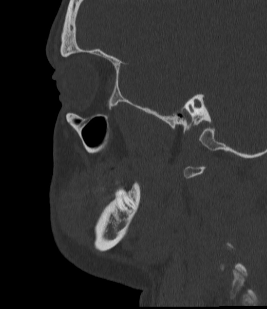 Normal facial bone CT (Radiopaedia 88742-105476 Sagittal bone window 120).jpg
