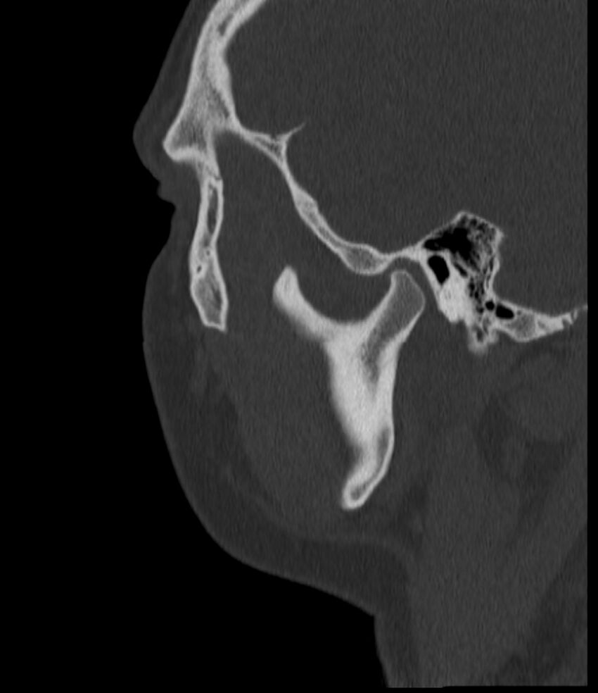 Normal facial bone CT (Radiopaedia 88742-105476 Sagittal bone window 38).jpg