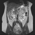 Normal liver MRI with Gadolinium (Radiopaedia 58913-66163 Coronal T2 19).jpg