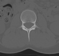 Normal lumbar spine CT (Radiopaedia 46533-50986 Axial bone window 25).png