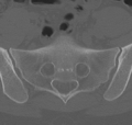 Normal lumbar spine CT (Radiopaedia 46533-50986 Axial bone window 72).png