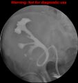 Normal retrograde pyelography of a native and transplant kidney (Radiopaedia 40480-43054 Transplant kidney 13).jpg
