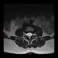 Normal spine MRI (Radiopaedia 77323-89408 Axial T2 7).jpg