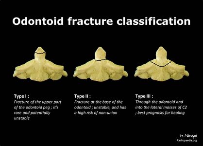 Odontoid fracture classification- diagram (Radiopaedia 21310).jpg