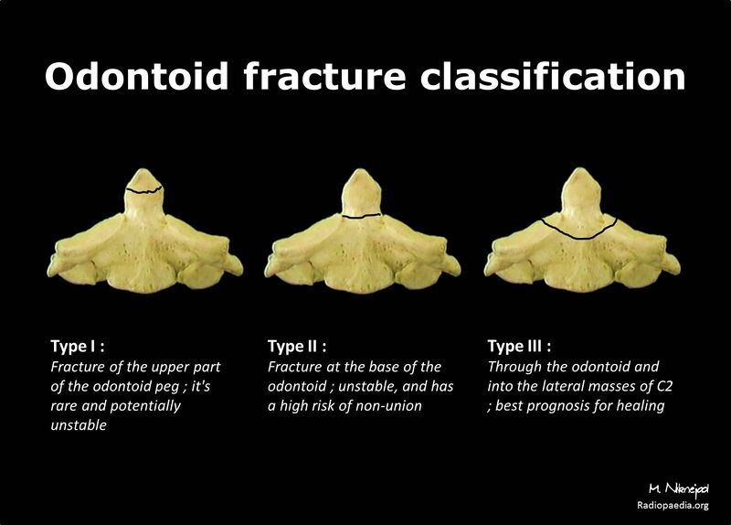 File:Odontoid fracture classification- diagram (Radiopaedia 21310).jpg