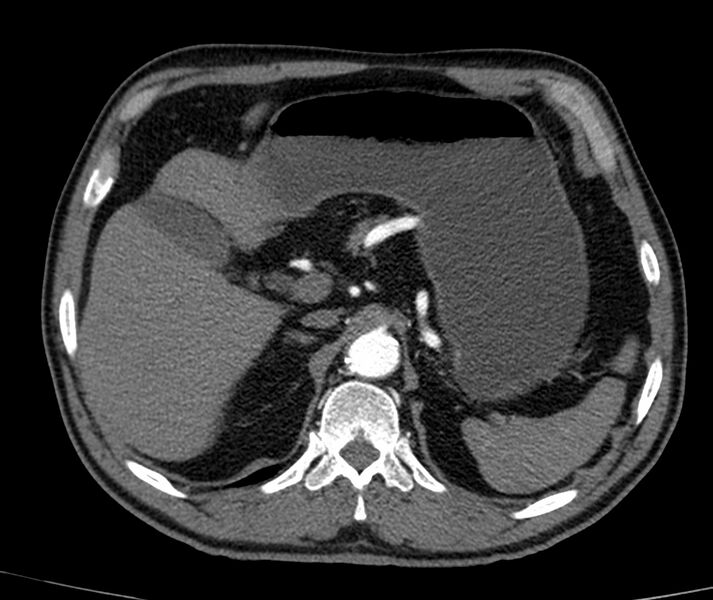 File:Abdominal aortic aneurysm (Radiopaedia 22421-22458 C+ arterial phase 11).jpg