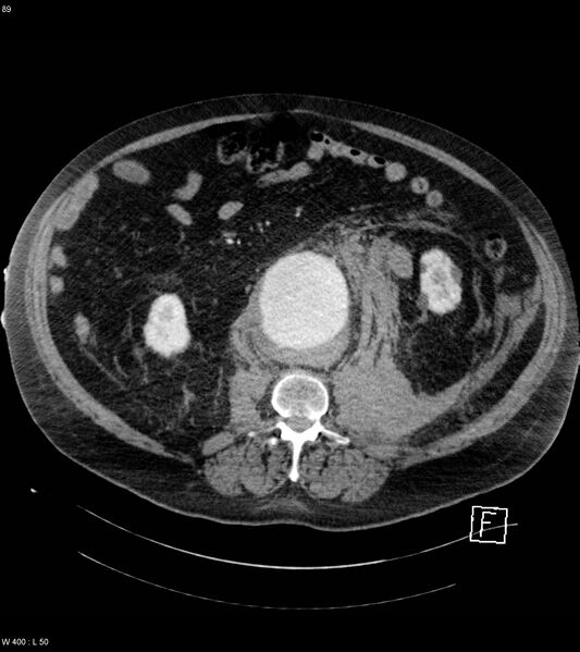 File:Abdominal aortic aneurysm with intramural hematoma then rupture (Radiopaedia 50278-55632 Axial C+ arterial phase 88).jpg
