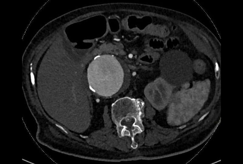 File:Abdominal aortic aneurysm with thrombus fissuration (Radiopaedia 73192-83919 Axial C+ arterial phase 54).jpg
