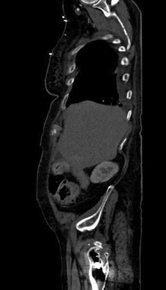 File:Abdominal aortic aneurysm with thrombus fissuration (Radiopaedia 73192-83919 Sagittal C+ arterial phase 121).jpg