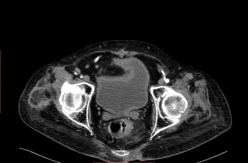 Abdominal aortic interposition tube graft and aneurysm thrombosis (Radiopaedia 71438-81857 Axial C+ arterial phase 222).jpg