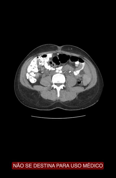 File:Abdominal desmoid tumor (Radiopaedia 44024-47540 Axial C+ arterial phase 19).jpg