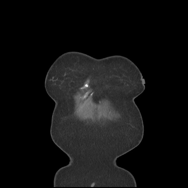 File:Aberrant right subclavian and left vertebral arteries (Radiopaedia 43467-46847 Coronal C+ portal venous phase 1).jpg