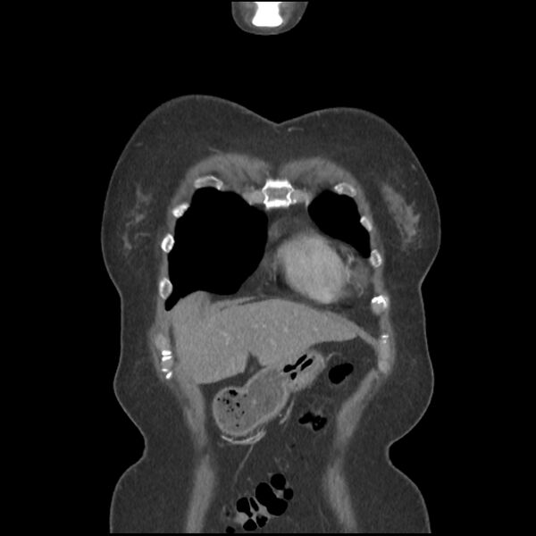 File:Aberrant right subclavian and left vertebral arteries (Radiopaedia 43467-46847 Coronal C+ portal venous phase 12).jpg