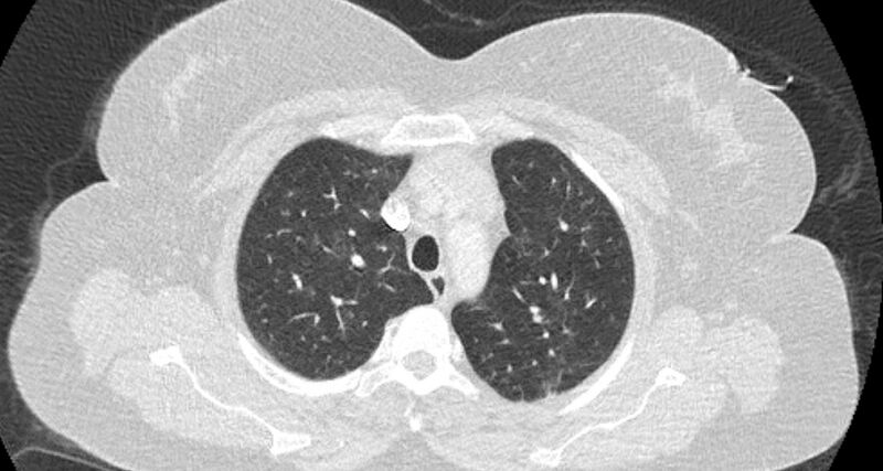 File:Accessory right inferior hepatic vein (Radiopaedia 65245-74259 Axial lung window 11).jpg