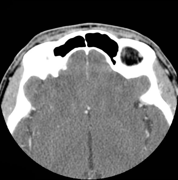 File:Acinic cell carcinoma of the lacrimal gland (Radiopaedia 9480-10160 Axial C+ arterial phase 12).jpg