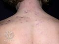 Acne affecting the back images (DermNet NZ acne-acne-back-171).jpg