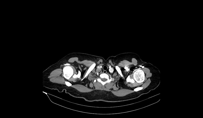 File:Acquired tracheo-esophageal fistula (Radiopaedia 51356-57103 Axial C+ arterial phase 7).jpg