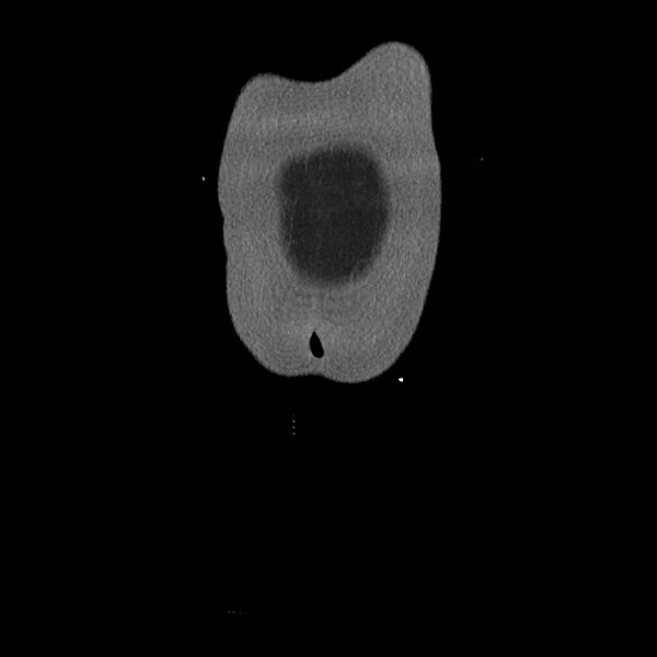 File:Active colonic bleed on CT (Radiopaedia 49765-55025 Coronal art MIP 5).jpg