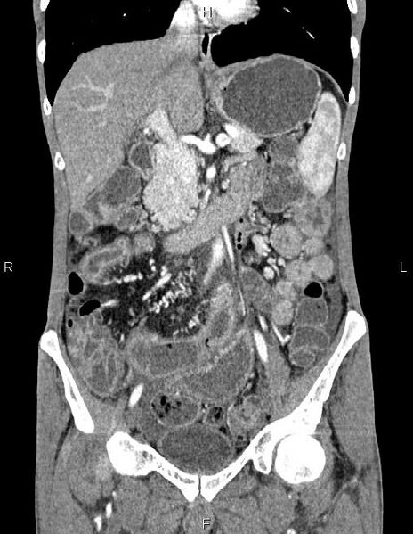 File:Active crohn disease (Radiopaedia 87133-103397 Coronal C+ arterial phase 28).jpg