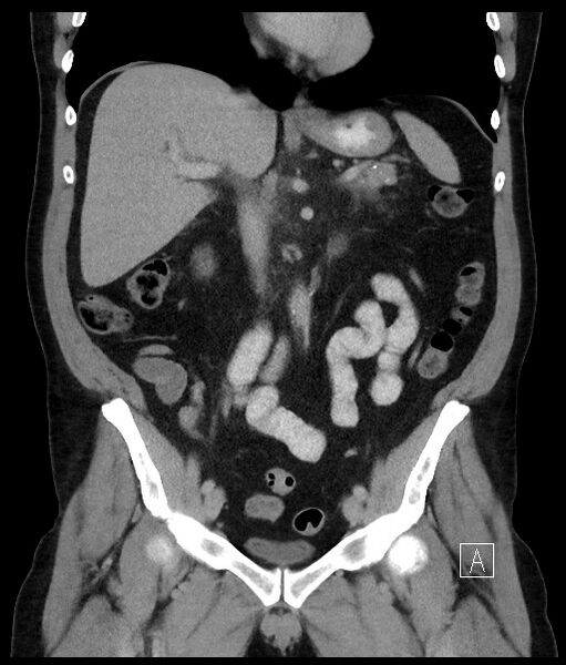 File:Acute-on-chronic pancreatitis (Radiopaedia 67286-76656 Coronal C+ portal venous phase 40).jpg