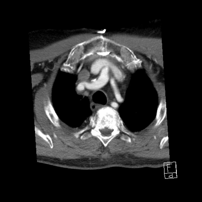 Acute ICA ischemic penumbra due to high-grade CCA stenosis (CT perfusion) (Radiopaedia 72038-82530 Axial C+ arterial phase 75).jpg