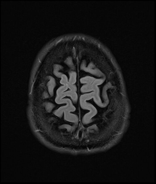 File:Acute P1 occlusion with PCA ischemia penumbra (CT perfusion) (Radiopaedia 72084-82590 Axial FLAIR 34).jpg