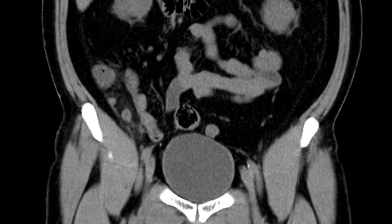 File:Acute appendicitis (Radiopaedia 13030-13091 Coronal non-contrast 9).jpg