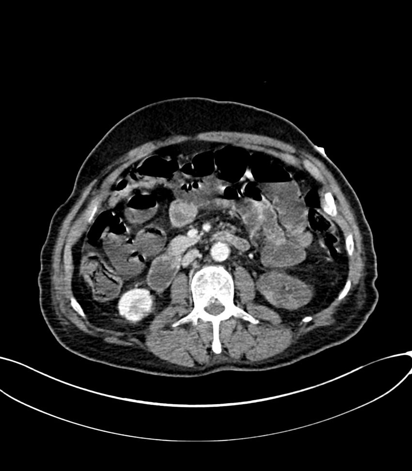 Acute arterial mesenteric ischemia (Radiopaedia 78238-90828 Axial C+ portal venous phase 61).jpg