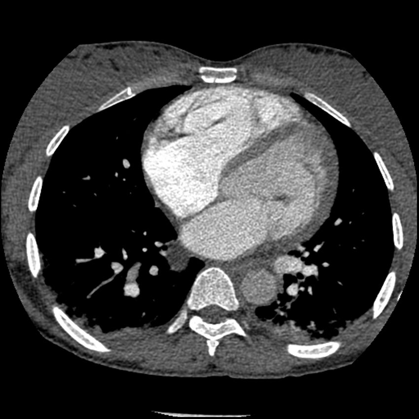 Acute chest syndrome - sickle cell disease (Radiopaedia 42375-45499 Axial C+ CTPA 115).jpg