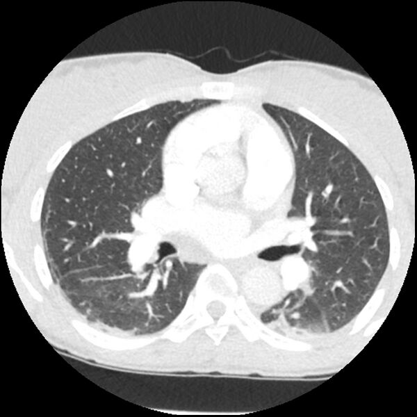 File:Acute chest syndrome - sickle cell disease (Radiopaedia 42375-45499 Axial lung window 91).jpg