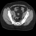 Acute cholecystitis and ureteric colic (Radiopaedia 42330-45444 Axial prone 90).jpg