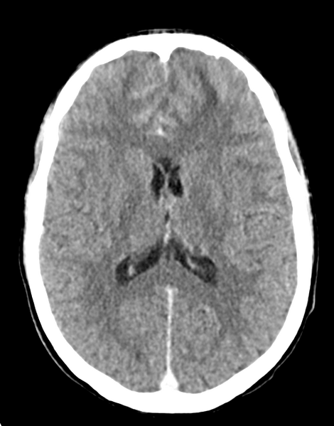File:Acute disseminated encephalomyelitis (ADEM) (Radiopaedia 65319-74348 Axial C+ delayed 18).png