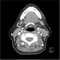 Acute left parotid sialadenitis (Radiopaedia 26160-26295 C+ arterial phase 30).jpg